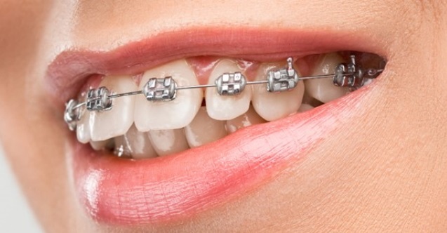 Ortodonti Tedavisi Nedir Ortodonti Tedavi Türleri