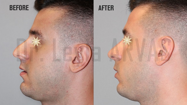 Burun Dolgusu İşlemi Nedir, Nasıl Yapılır? Ameliyatsız Burun Estetiği Ne İşe Yarar? İşte Tüm Detaylar…