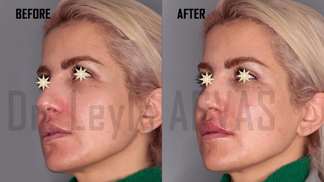 Gözaltı Dolgusu Operasyonu Gözaltı Dolgusu Nedir