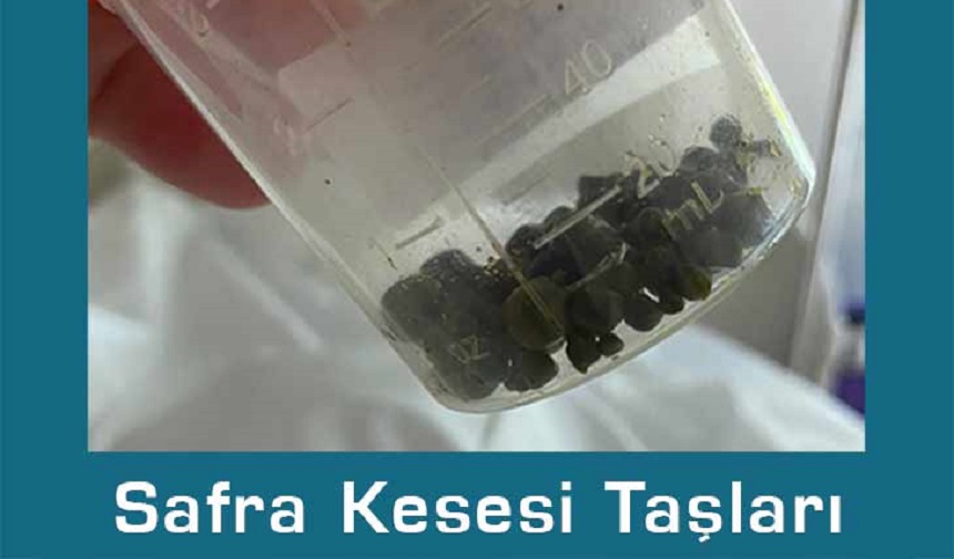 safra kesesi ameliyatı