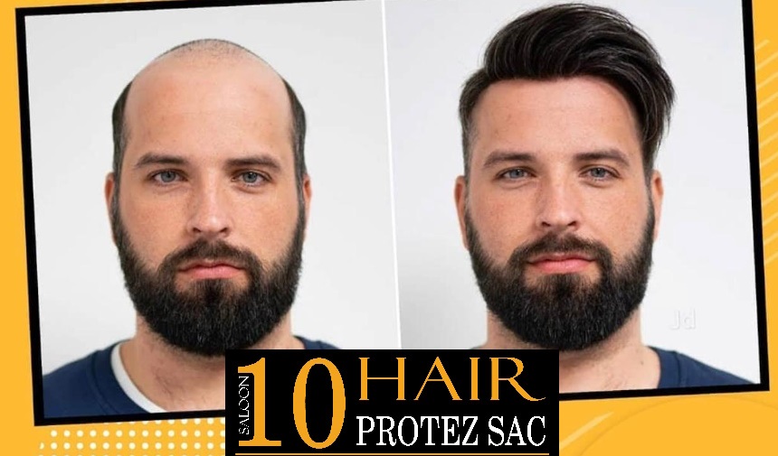 izmir protez saç merkezi