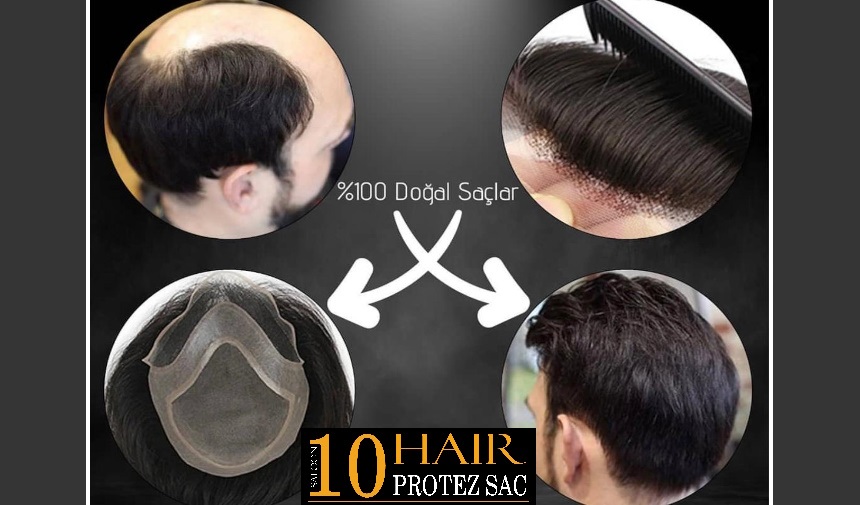 izmir protez saç merkezi