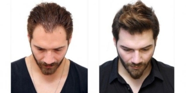 Protez Saç Bakım Ürünleri