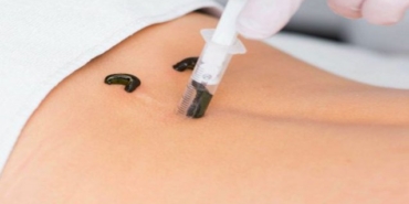 Sülük Tedavisi Faydaları Nelerdir?