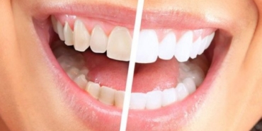 Diş beyazlatma tedavisi hakkında merak edilenler