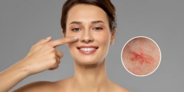 Kılcal Damar Tedavisi Nedir? Nasıl Yapılır?