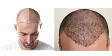 Saç Ekimi Nasıl Yapılır? Hiperbarik Saç Ekimi Nedir?