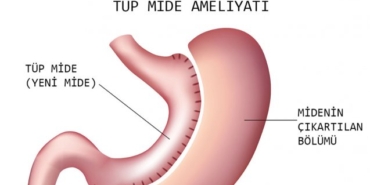 Tüp Mide (Sleeve Gastroctemy) Ameliyatı Nedir?