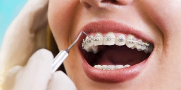 Ortodontik tedavide diş telleri mi, şeffaf plaklar mı?