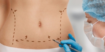Liposuction Nedir? Nasıl Uygulanır?