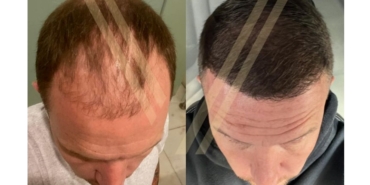 Sağlık Turizminde Türkiye ve Saç Ekimi