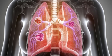 Akciğer Kanseri Tedavisi