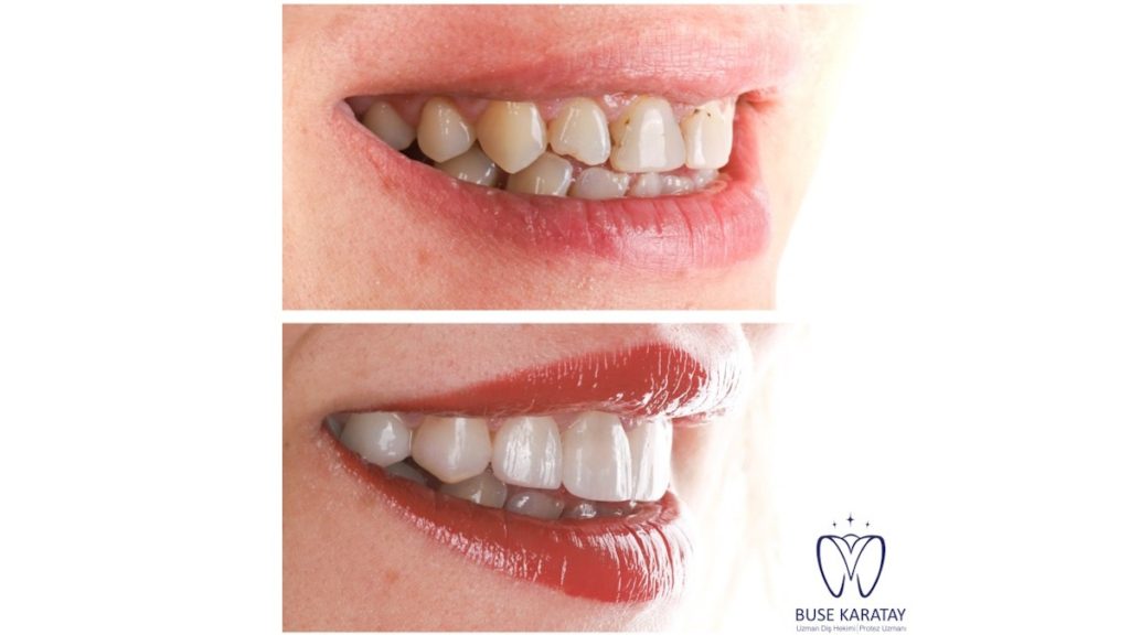 porselen diş izmir kliniği