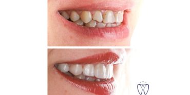 porselen diş izmir kliniği