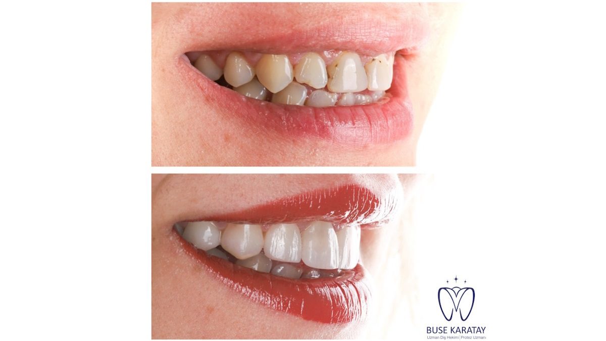 porselen diş izmir kliniği