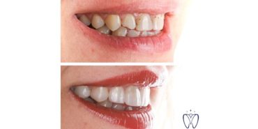 Şeffaf Plak Tedavisi Konforuyla Öne Çıkıyor