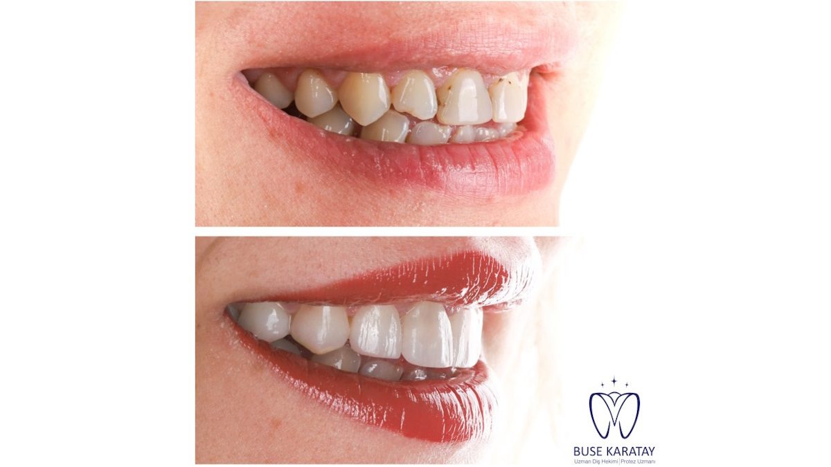 Şeffaf Plak Tedavisi Konforuyla Öne Çıkıyor