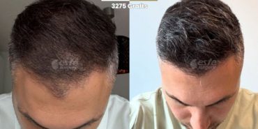 Profesyonel fue technique